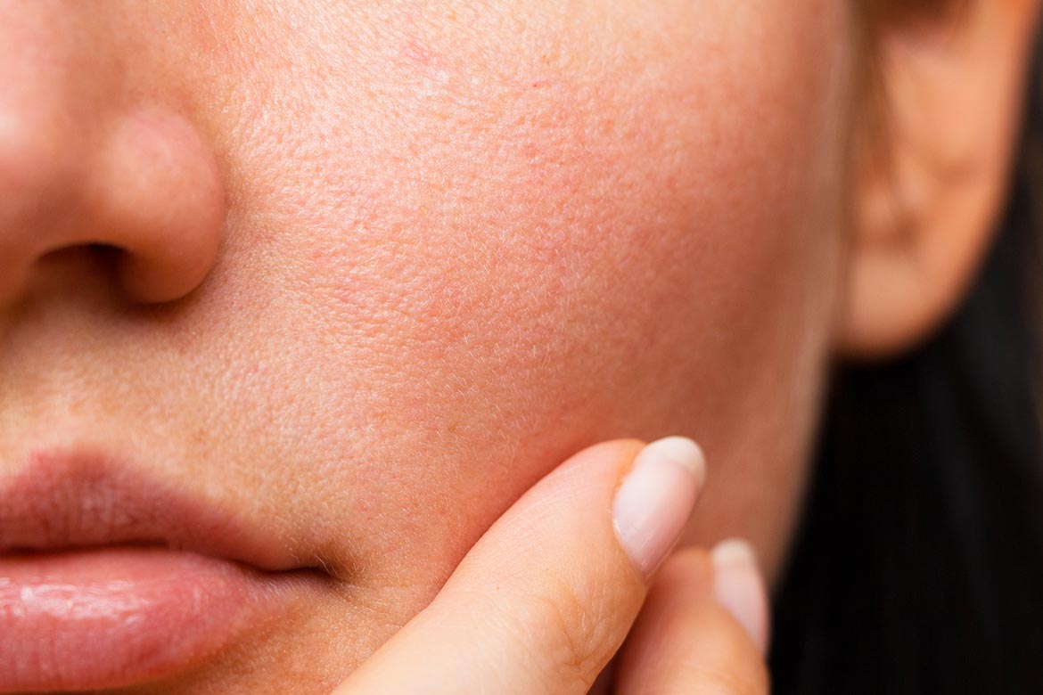 Pori dilatati e pelle lucida? Ecco la skincare per riequilibrarli